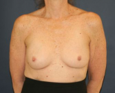 Feel Beautiful - Ruptured Breast Implants - Before Photo
